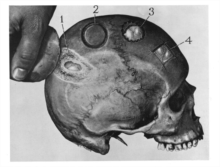Were mystery holes in skulls an ancient aspirin?